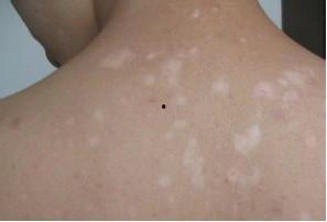 白癜风可以吃瓜么,瓜类食物的适宜与禁忌