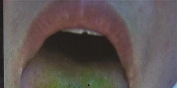 吃瓜舌苔发白,揭秘吃瓜为何导致舌苔发白